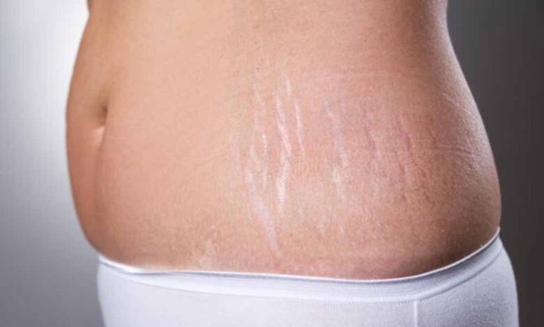 कुछ-घरेलू-चीजों-की-मदद-से-स्ट्रेच-मार्क्स-होंगे-दूर